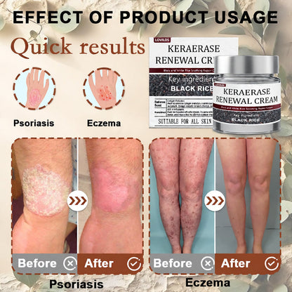 ✅Flash Sale - KeraErase Dual-Action Renewal Cream